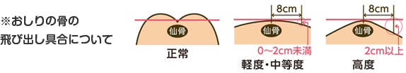 おしりの骨の飛び出し具合についての図解